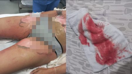 Mulher tem 50% do corpo queimado após briga com esposa no litoral catarinense